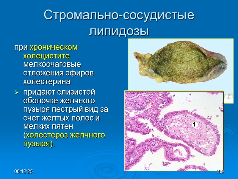 08:12:02 Стромально-сосудистые  липидозы при хроническом холецистите мелкоочаговые отложения эфиров холестерина  придают слизистой